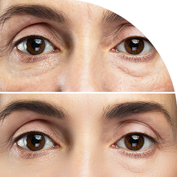 Tratamiento de estética para reducir bolsas de ojos con radiofrecuencia